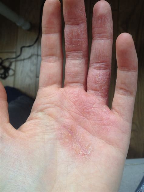 Dyshidrotic Eczema Between Fingers