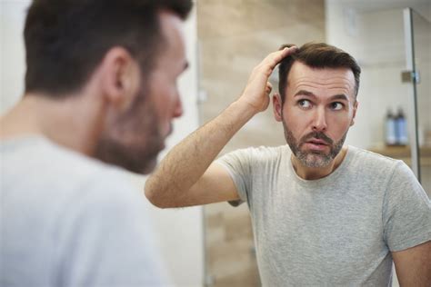how to know if you have a receding hairline