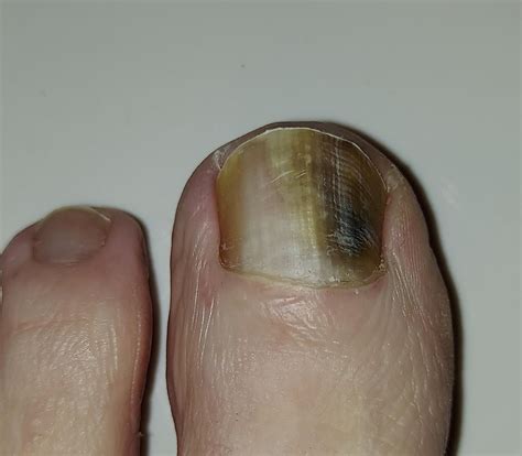 Discolored and raised toenail(s) after injuries; Dystrophic, Melanoma