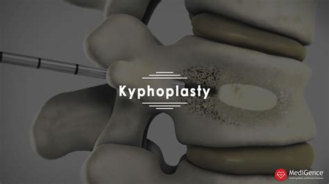 Kyphoplasty: Causes Symptoms and Recovery