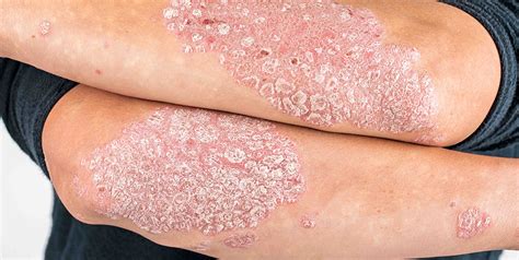 plaque psoriasis clinical trial moderate  severe  months