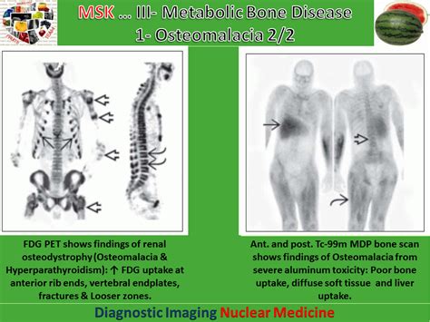 Easy Radiology: Metabolic bone disease