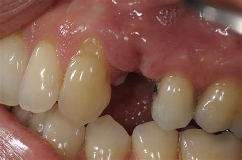 Ridge Preservation with GTO - Case - BBB Academy