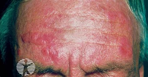 Chronic actinic dermatitis image