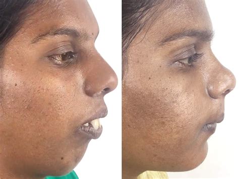 CHIN AUGMENTATION - Richardson dental and craniofacial Hospitalposts