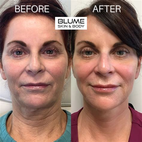 levisa lazer: Before & After Photos That Will Amaze You - u1or2g2