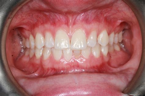 Braces San Diego at Julius Scudder blog