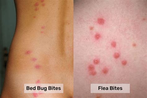 Bed bugs bite vs. Flea Bite: What's the Difference? - Pest Control Gurus