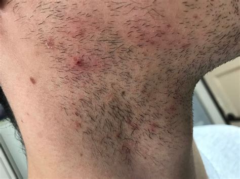 Derma-Docència Castelló: Un acné en la barba que no mejora...