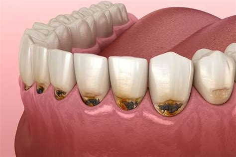 rang bi nhung cham den nho nguyen nhan va cach dieu tri