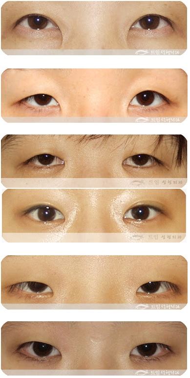 Epicanthic Fold Types