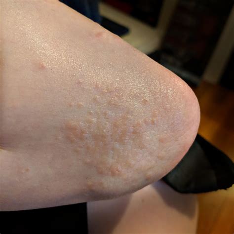 Please help. Ive had these itchy bumps on my elbow for about a month