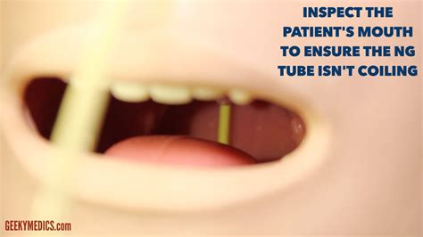 What To Do If Ng Tube Comes Out at Clifford Ward blog