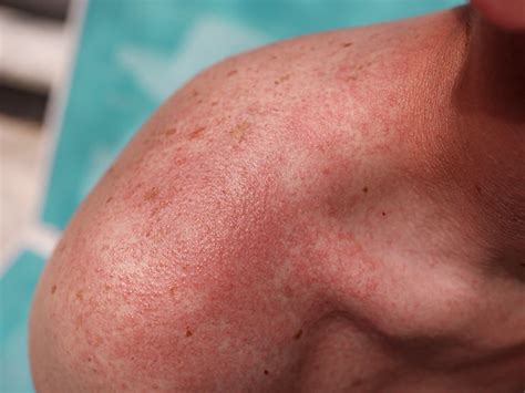Nice Tips About How To Get Rid Of Heat Rash On Face - Welfareburn20