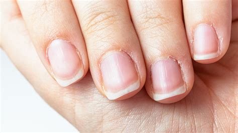 Psoriatic Arthritis Nails: Understanding Symptoms and Nail Health