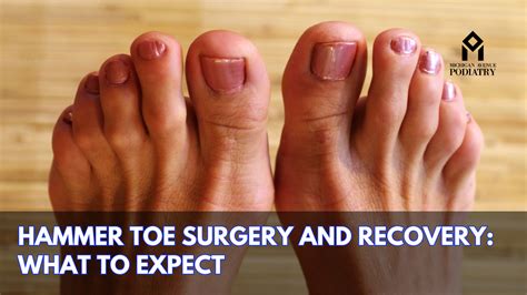 Hammer Toe Surgery And Recovery: What To Expect