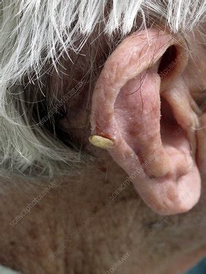 cutaneous horn stock image  science photo library