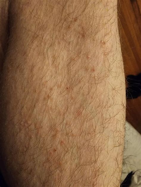 Dry, raised bumps on legs. : r/DermatologyQuestions