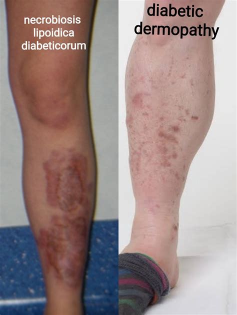 Diabetic Dermopathy
