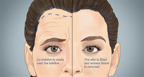 forehead lift ameliyatinin avantajlarini fidel clinic de kesfedin