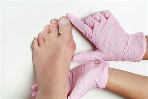 expect  bunion surgery cornerstone foot ankle