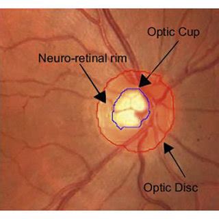 Structure of optic nerve head: (a) normal and (b) glaucoma [3]. | Download Scientific Diagram