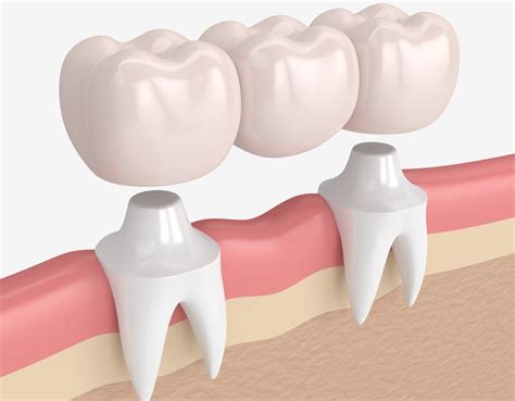 BRIDGES & CROWNS - Health Call