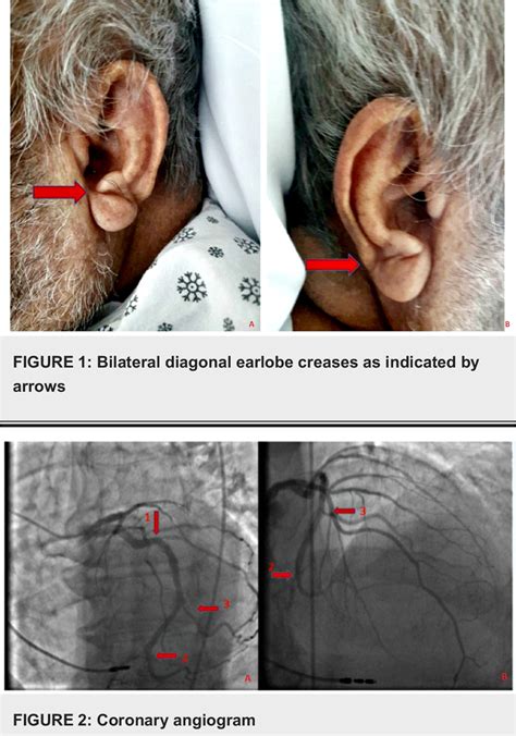 Figure 1 from Diagonal Earlobe Crease, a Marker of Coronary Artery ...