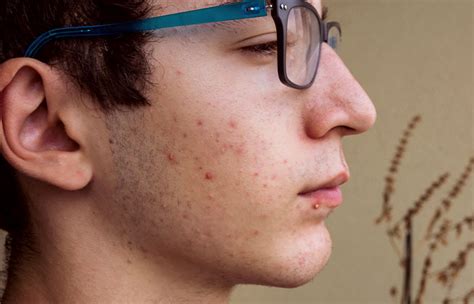 Stages of acne and how to get rid of it | Proactiv® Resource Hub