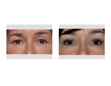Case Study: Upper Blepharoplasty (Eyelid Lifts) Under Local Anesthesia