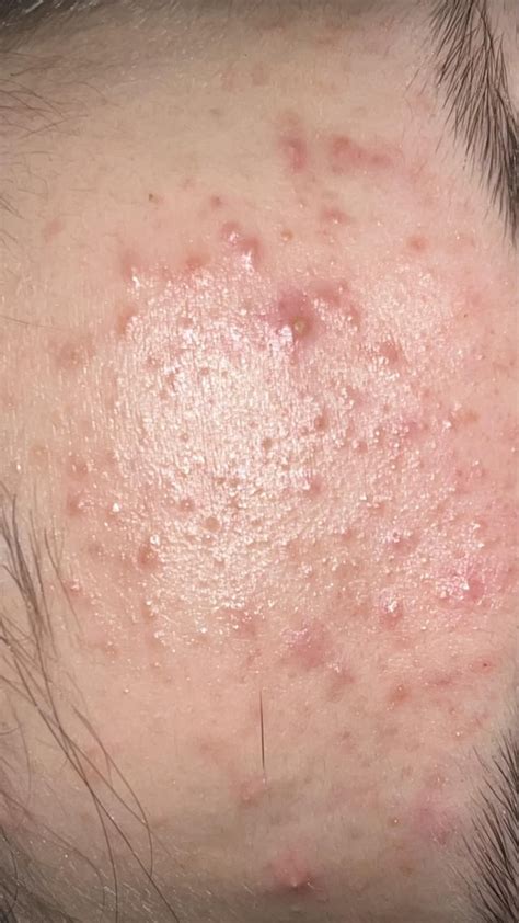 Why do i have red bumpy skin texture ? : r/Skincare_Addiction