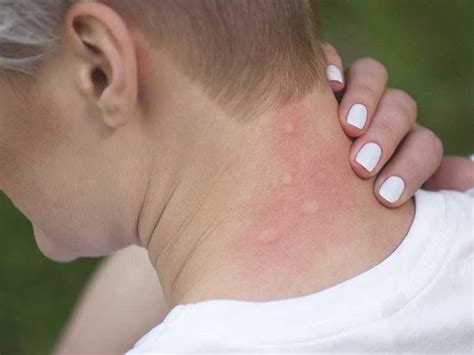 Red Ant Bites Children