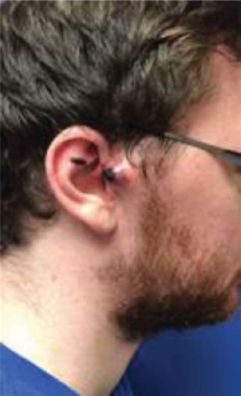 pulsatile periauricular mass  clinic