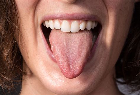 how to fix a burning tongue