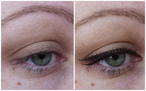 psoriasis eyelid - pictures, photos