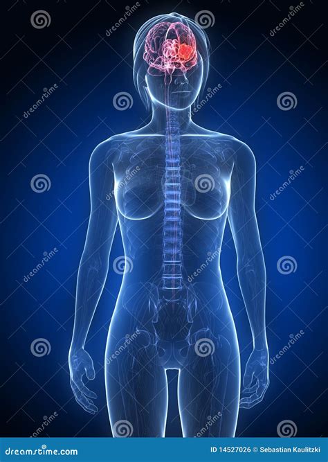 Cerebral tumor stock illustration. Illustration of stomach - 14527026