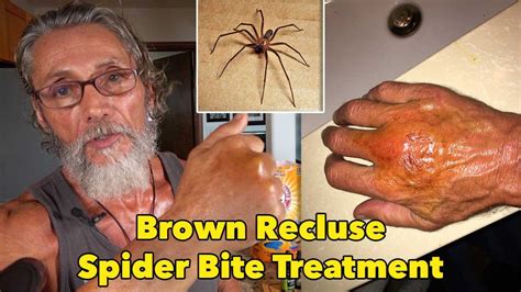 Brown Recluse Spider Bite Causes Symptoms Treatment Pictures Of Brown ...