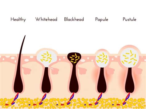 whiteheads  preventions treatments home remedies