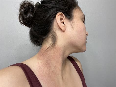 Pineapple Allergy Itchy Throat at Mackenzie Boehm blog