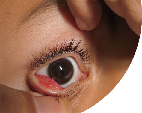 Types of Eyelid Cysts | Tunbridge Wells Eye Centre