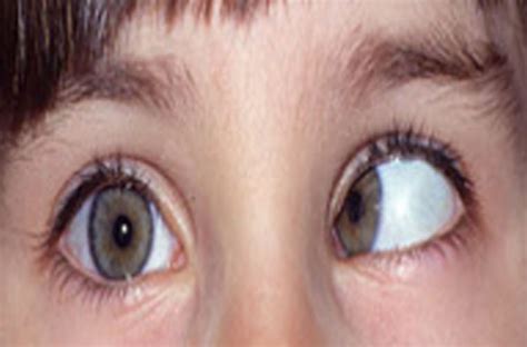 Crossed Eyes (Strabismus)