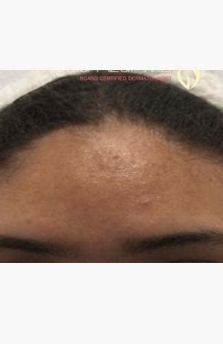 Before & After Gallery Acne | Pediatric And Adult Dermatology located ...