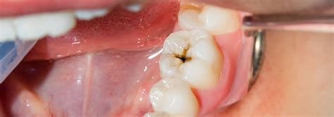 guide  preventing cavities  dental clinic  hyderabad