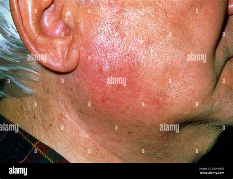 parotitis epidemicao ist parotitis ansteckend nwhvl