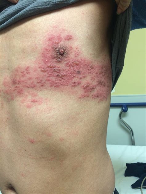Herpes
