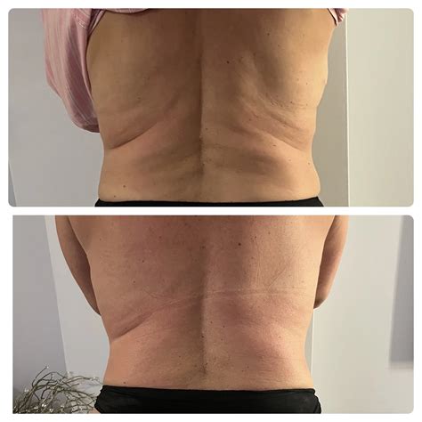 Body Contouring Miami | Free Consultation | Before and After — MyEMSHealth