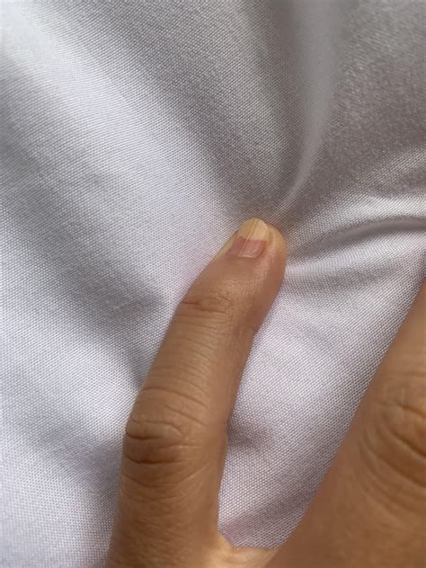 How can I restore the look of my natural nail post acrylic removal? The