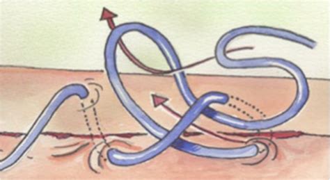 editorial ten commandments  safe  optimum abdominal wall closure