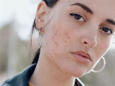 post inflammatory erythema   treatment