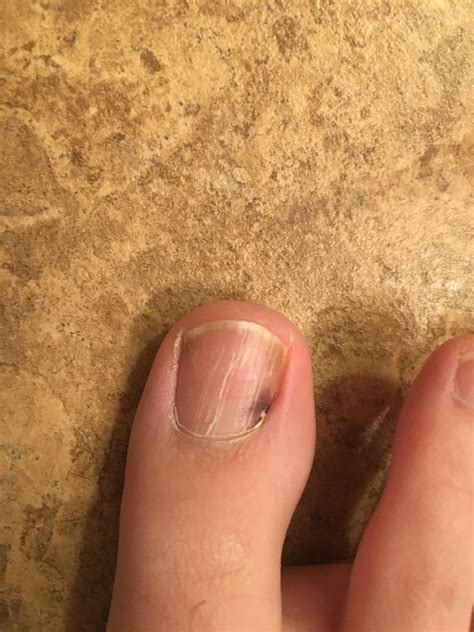 Skin Cancer Under Toenail Beauty Queen Discovers Bruise On Her Finger